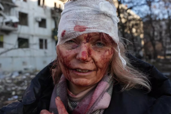 폭격으로 부상당한 우크라이나 민간인 여성 (게티이미지